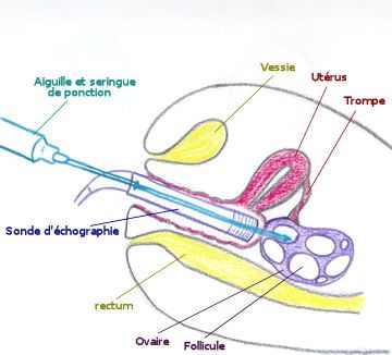 prelevement ovocyte prelevement ovocyte
