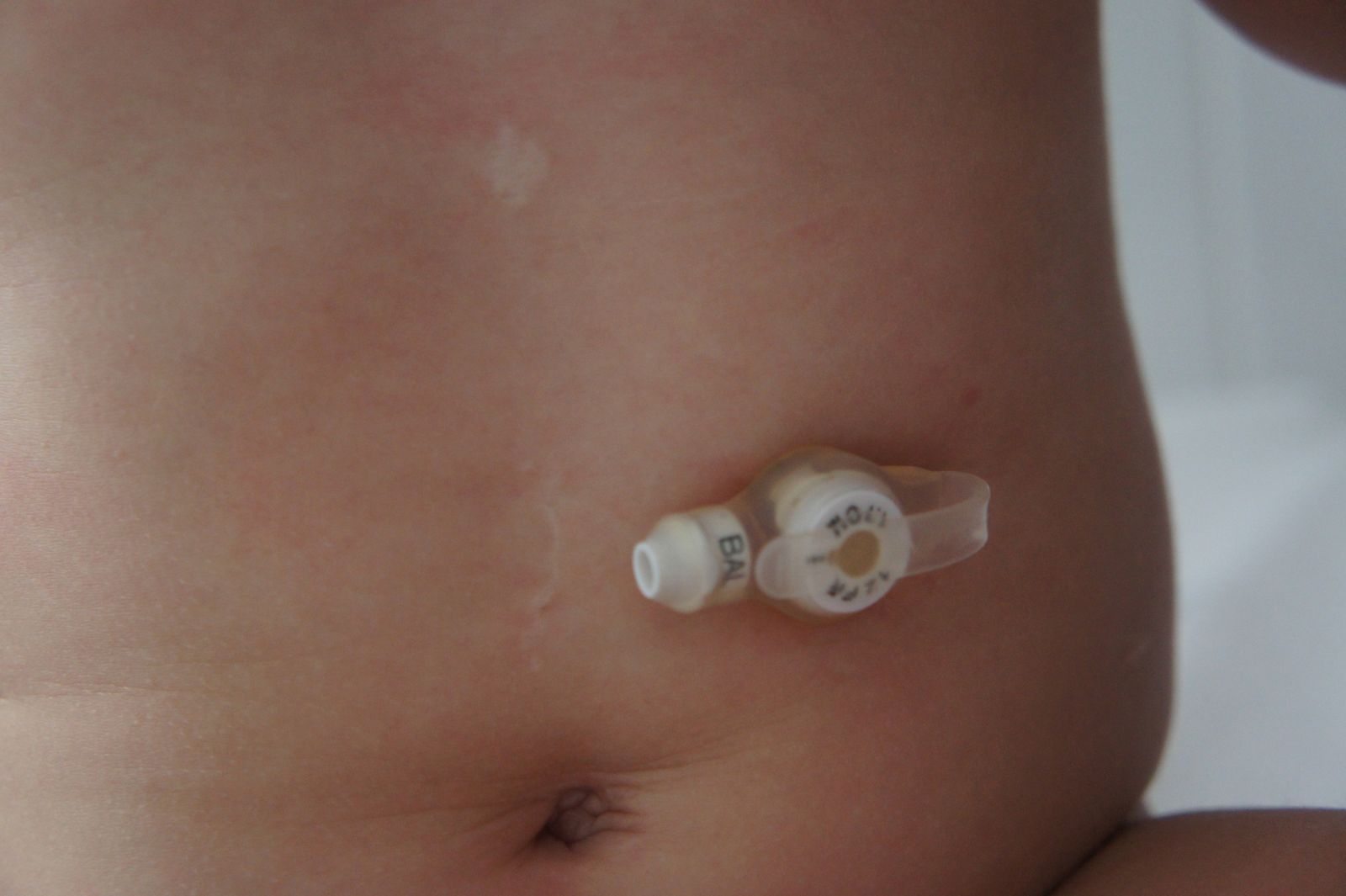 Le bouton de gastrostomie nourrit directement l'estomac