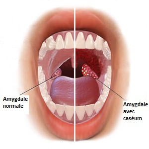 Caséum : comment enlever les aliments coincés dans les amygdales ?