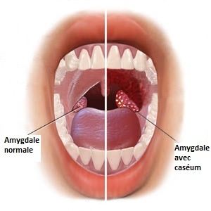 Le caséum donne une très mauvaise haleine 🤢 #haleine #caseum #bouche