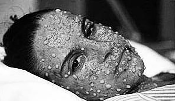 Epidémie de variole - Aigueblanche autrefois