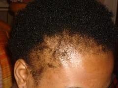 comment traiter les chutes de cheveux afro