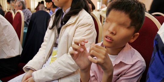 Un Vietnamien de 14 ans, victime supposée de l'agent orange. | AFP/HOANG DINH NAM Un Vietnamien de 14 ans, victime supposée de l'agent orange.