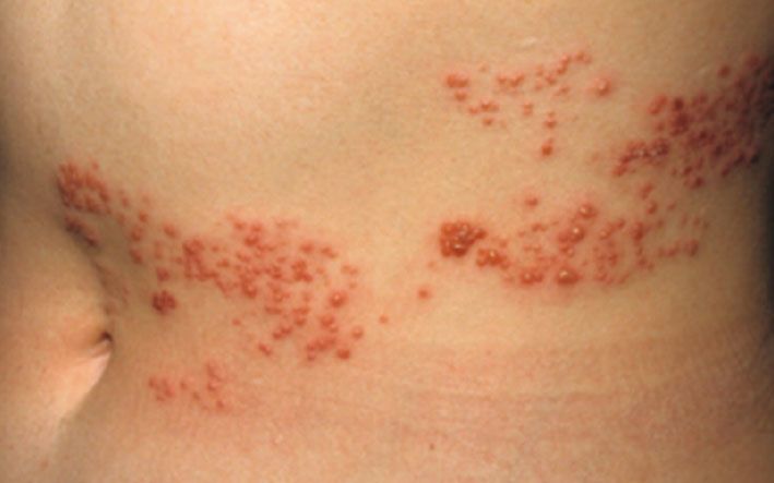 De quoi il y a des boutons sur la personne dans 14 ans