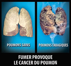 Comme cessera de fumer la méthode nationale
