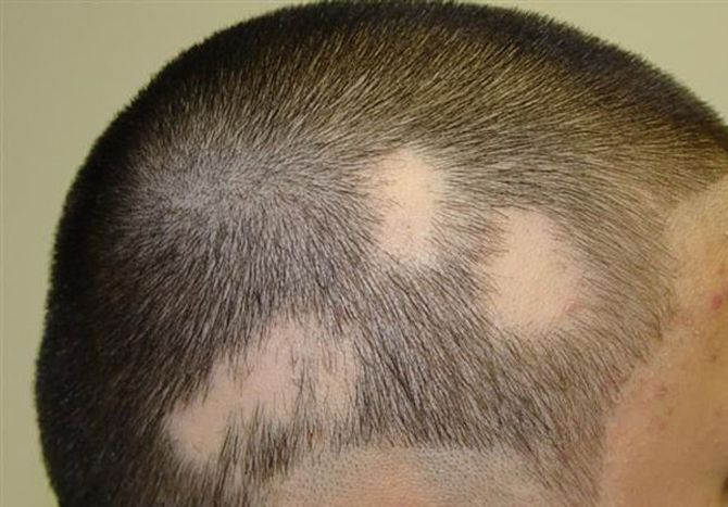 Remedios naturales para la alopecia areta - Salud Y Belleza Natural