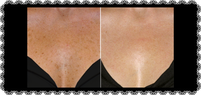 Bodyaga aux taches de pigment