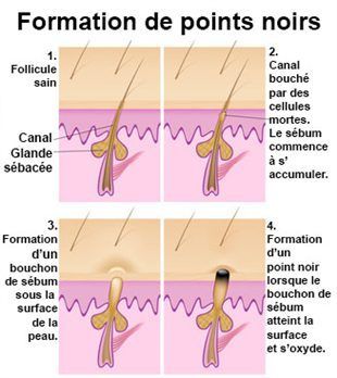 comment debarrasser des points noirs comment debarrasser des points noirs