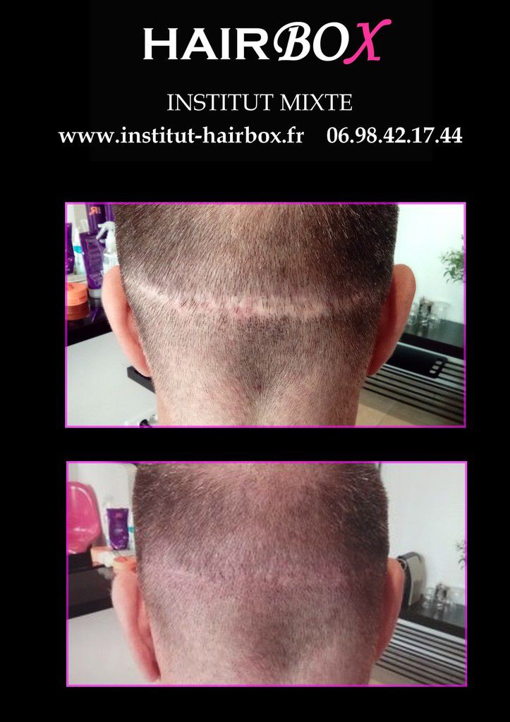 couvrir une cicatrice par tricopigmentation, micropigmentation, tatouage, institut hairbox