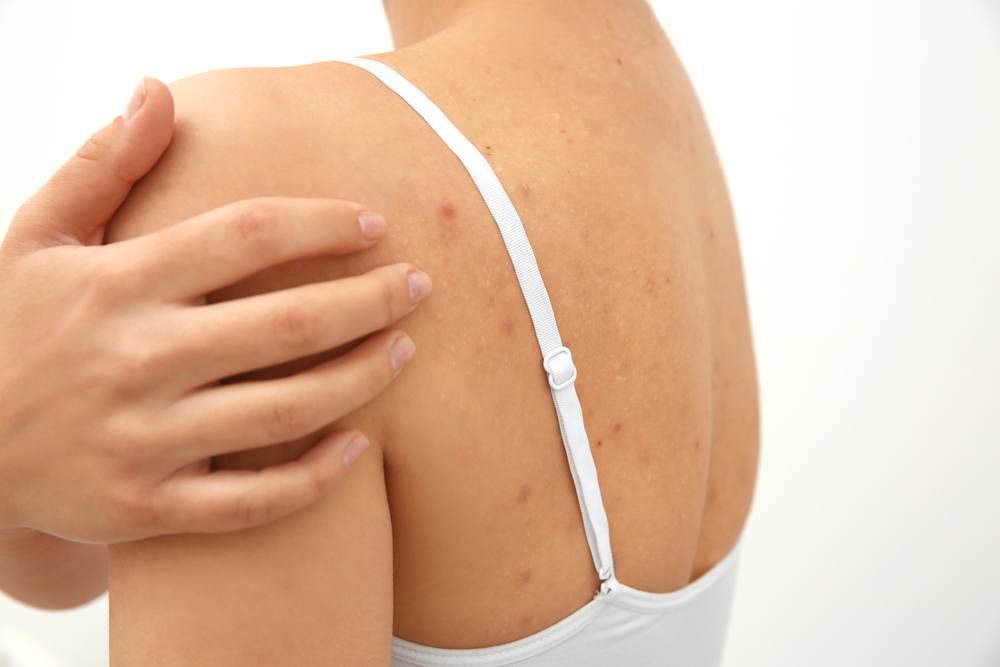 Comment se débarrasser des boutons d'acné dans le dos ? (astuces,  conseils...) - Copines, Mamans et Femmes (très) actives