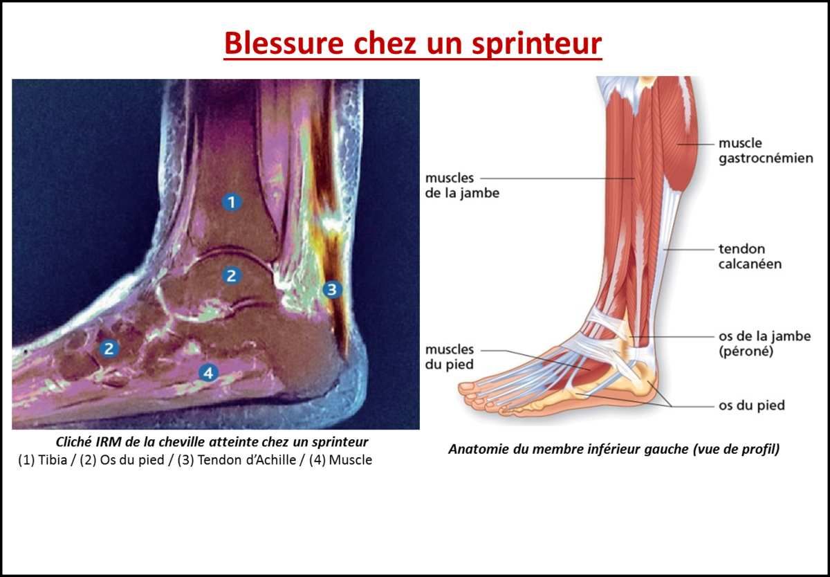 2nde_Exercice : Blessures musculo-articulaires - profSVT 2nde_Exercice : Blessures musculo-articulaires - profSVT