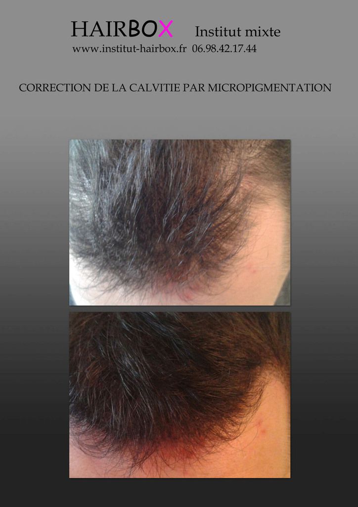 Micropigmentation capillaire tatouage cheveux hairbox