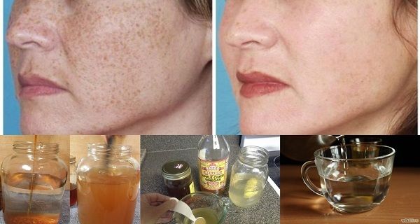 Comme réduire la pigmentation de la personne