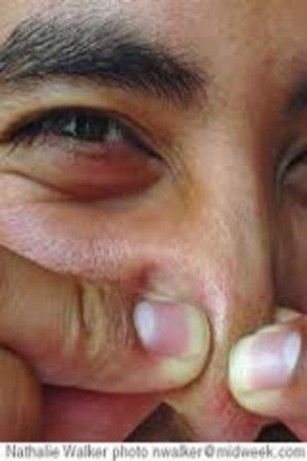 How To Remove Blackheads Successfully How To Get Rid Of
