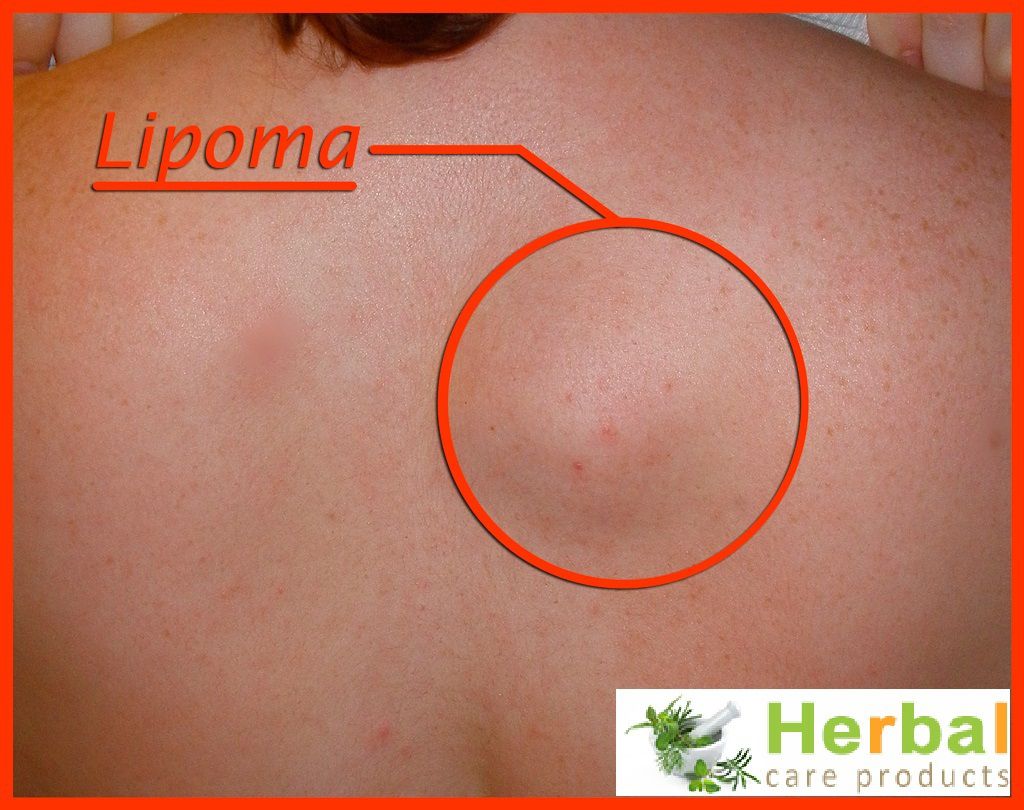 Lipoma removal the most effective method 33 Lipoma removal the most effective method 75