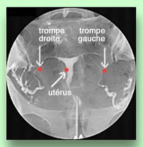 hysterosalpingographie trompe bouchée hysterosalpingographie trompe bouchée