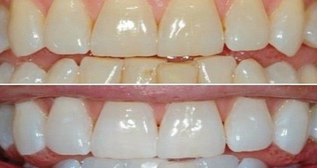 Blanchir ses dents avec le bicarbonate - Sourire d'orient