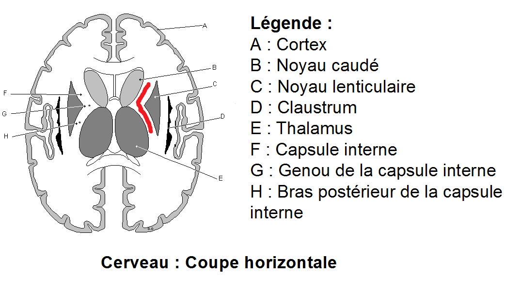 Troubles moteurs hémiplégie, hémiparésie AVC