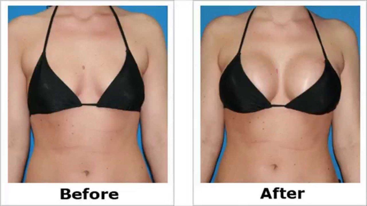 breast before after Breast before after