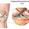Ruptura de ligament incrucisat anterior