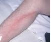 PARAPHLEBITE