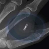 Implants des puces électroniques dans le corps : nouveaux usages de la RFID - OOKAWA Corp.