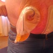Fumer peut donner le cancer de la vessie