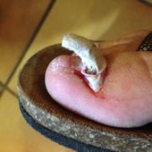 Photo d'onychomycose responsable d'un ongle arraché
