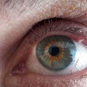 Inflammations de l'oeil: Orgelet-chalazion-conjonctivite-Blepharite