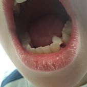 Dents de lait: Elles poussent quand? Elles tombent quand?
