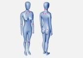 Fibromyalgie, Generalisiertes Weichteilrheuma