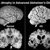 C'est confirmé, l'aluminium favorise la maladie d'Alzheimer - MOINS de BIENS PLUS de LIENS