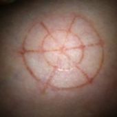 Etranges dessins circulaires qui apparaissent sur les gens en France et dans le monde