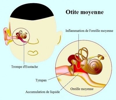 Comment soigner une otite naturellement - La Fée Rie de Stef