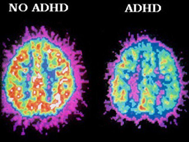 Differences the ADHD and the Non-ADHD Brain - Hillcrest Adolescent Center