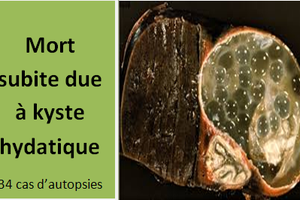 Mort subite due à kyste hydatique: 34 cas d’autopsies médico-légales