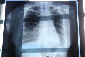 Tuberculose, une maladie en voie d'éradication !