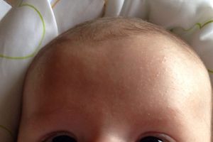 Bébé a des boutons sur le visage... l'acné du nourrisson