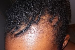 Challenge : pousse des cheveux sur les tempes