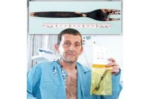 VIVIÓ 10 AÑOS CON TENEDOR EN EL ESTÓMAGO, NOTICIAS INSOLITAS