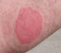 Are Bed Bugs The Reason For That Rash? - Bed Bugs