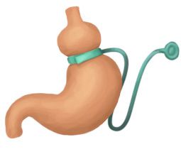 Chirurgie bariatrique : anneau gastrique, sleeve, by-pass
