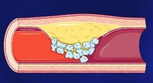 Cholestérol, Statines et infarctus