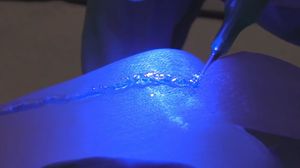 Réparer les fractures avec un stylo
