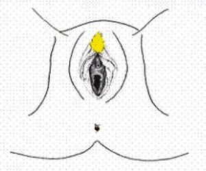 Mutilazione genitali femminili, la pratica della vergogna
