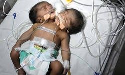 Un bébé à deux têtes en Inde