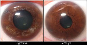 Resolución Glaucoma infantil: Sí hubo imprudencia y mala praxis