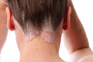 Remedies of Dandruff