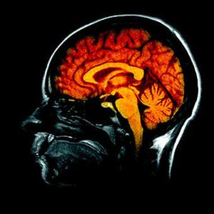 Les cerveaux des autistes créeraient plus d'informations