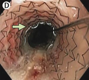 ROYAL MONACO MEDECINE: Comment traiter le reflux gastro-oesophagien ?